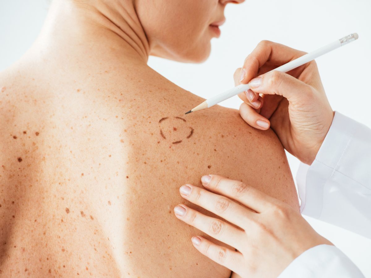 Licensed provider performing electrocauterization for skin lesion removal at The Spa by Sheena.